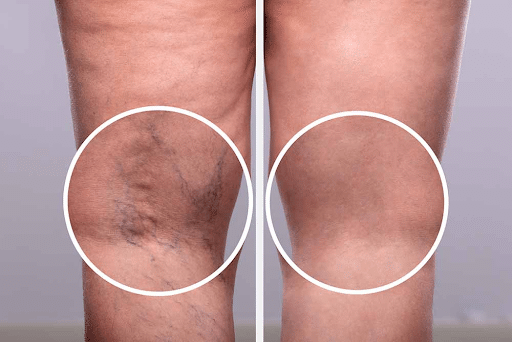 Yorkville Vein Clinic - Endovenous Laser Ablation Therapy