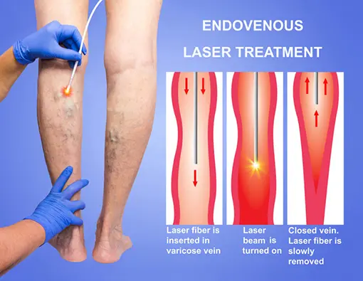 Yorkville Vein Clinic - Endovenous-Laser-Treatment-Diagram