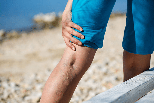 Yorkville Vein Clinic - varicose vein