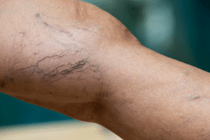 Yorkville Vein Clinic spider veins